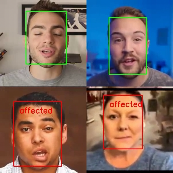 Facial Palsy Detection